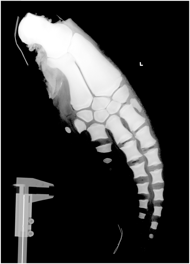 Ein Röntgenbild eines Männerbeins mit einem Bruch in der Mitte, mit einem Metallband auf der linken Seite, vor schwarzem Hintergrund.